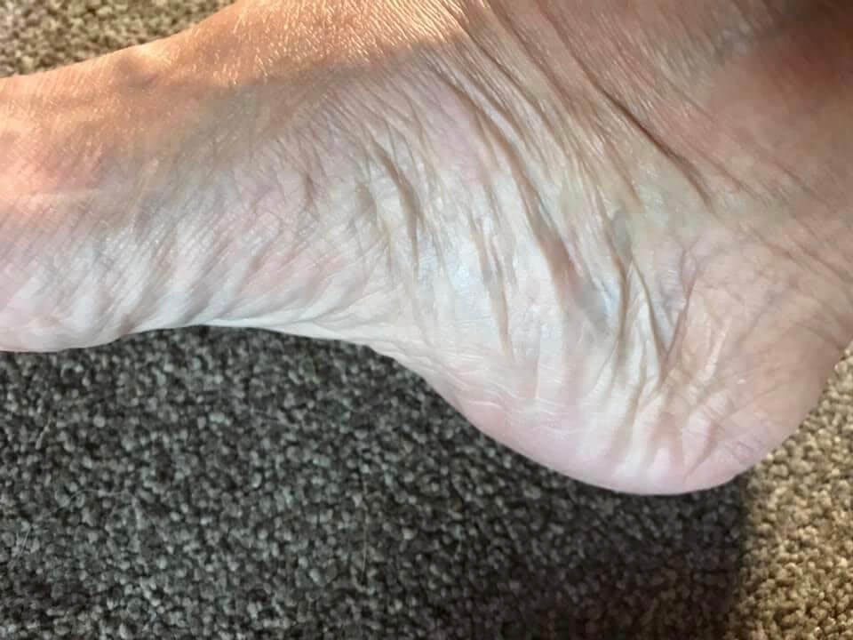 Exfoliating foot peel 